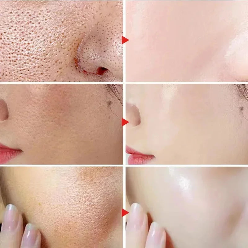 Lactic Acid Shrink Pores Serum Fast Large Pores Removal